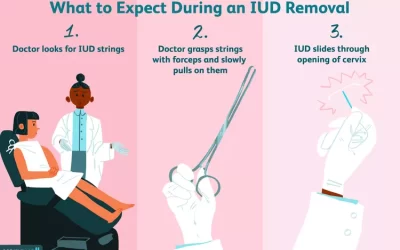 A Simple Guide to IUD Removal in a Doctor’s Clinic